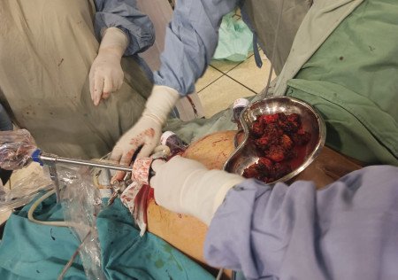 Fibroids treatment in Lahore Pakistan