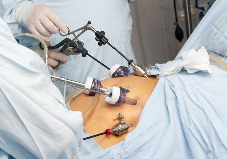 Minimally Invasive Surgery in Overweight Patients