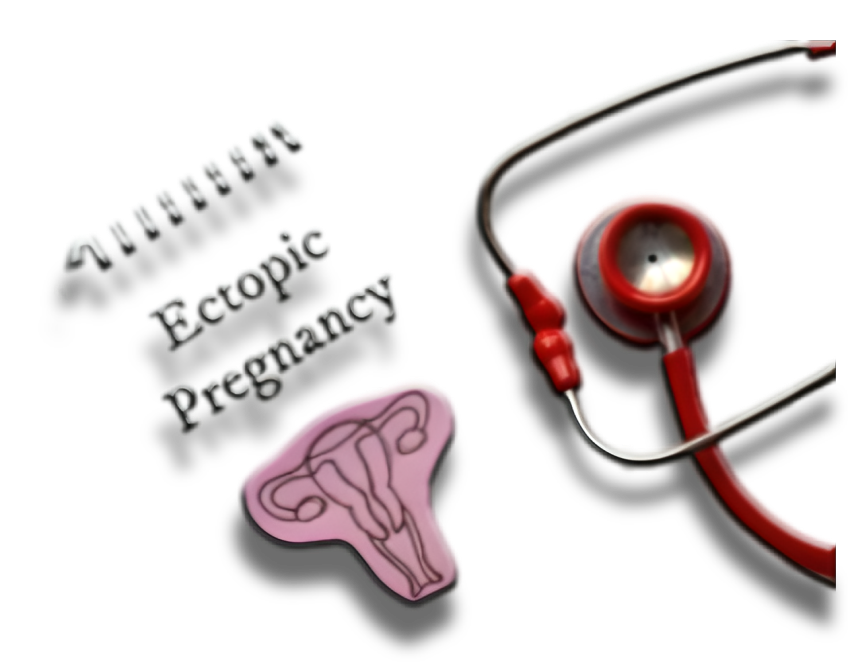Causes of Ectopic Pregnancy