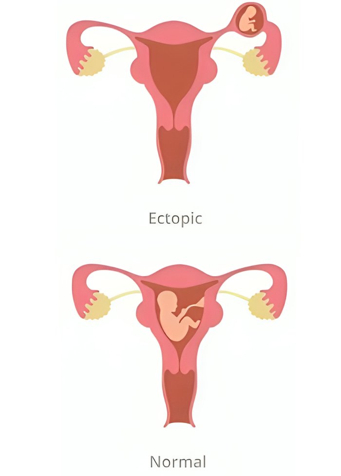 Ectopic Pregnancy