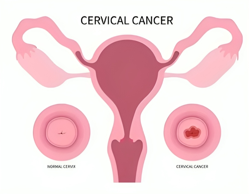 cervical-cancer
