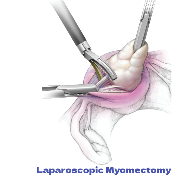 Laparoscopic Myomectomy