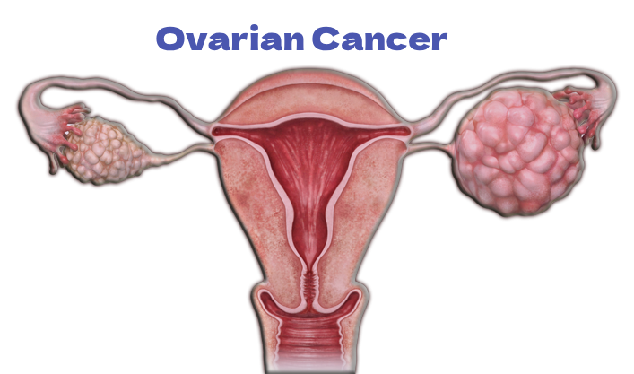 Ovarian Cancer/Tumor